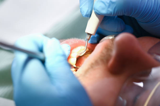 Best Emergency Tooth Extraction in Monon, IN