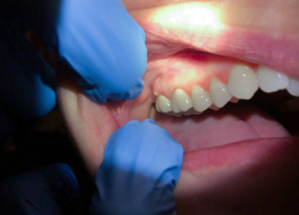 Best Emergency Treatment for Dental Infections or Abscesses in Monon, IN